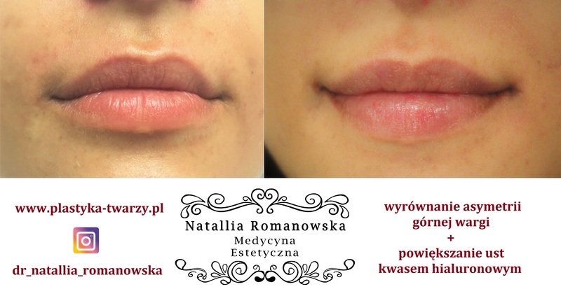 wyrównanie symetrii ust Romanowska