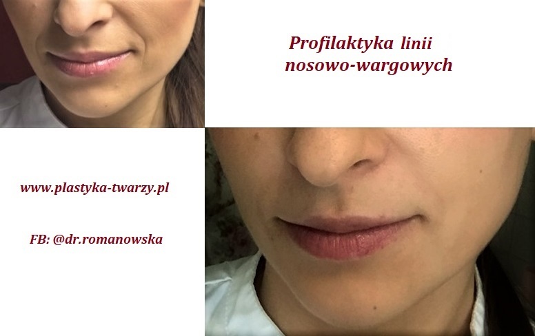 profilaktyka linii nosowo-wargowych