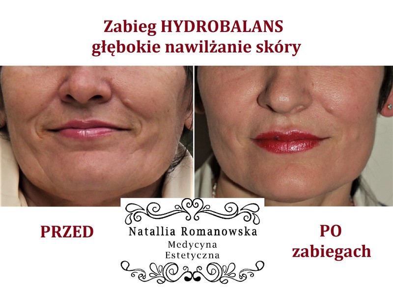 Zabieg hydrobalans głębokie nawilżenie skóry Romanowska Białystok